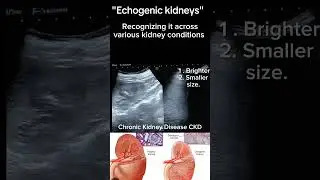 Echogenic Kidneys Disease on ultrasound #kidney #healthytips #ytshorts #shortsbeta  @Dr.Saimakhan