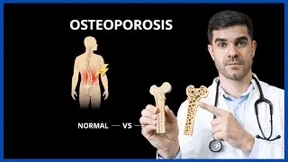 Densidade Mineral Óssea, Osteoporose e o que TODA mulher precisa entender para envelhecer bem