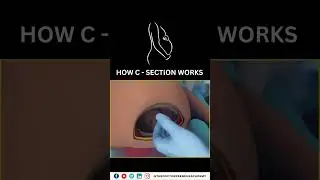 Cesarean Section Explained: Why Doctors Choose C-Sections for a Safer Birth 👶✂️ #Cesarean #Birth