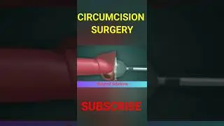 Circumcision Surgery 3D Animation #treatment #surgery #circumcision #shorts #3d #3danimation #viral
