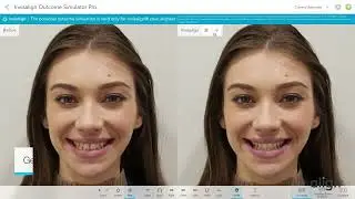 Increase Your Patients' Treatment Acceptance with iTero&trade; Intraoral Scanner