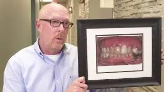 Sedation Provided The Best Option For Full Arch Dental Implant Procedure