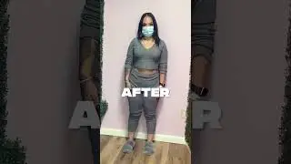-41 Lbs In 6 Month After Her Orbera Gastric Balloon Procedure 🔥❗️ #nonsurgicalweightloss