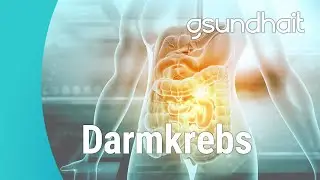 Darmkrebs: Immer mehr junge Menschen sind betroffen. Interview mit Prof. Dr. med. Robert Rosenberg