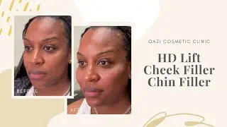 HD Lift + Cheek Fillers + Chin Fillers