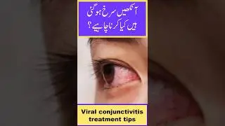 Pink eye prevention and treatment | Ashob-e-Chashm ehtiat aur Ilaj