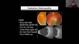 Ocular Surveillance, DNA Testing, Systemic Surveillance: Primary Uveal Melanoma Sessions and Q&A