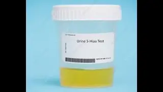 24 Hour Urine 5-HIAA Test (5-hydroxyindoleacetic acid)  to Diagnose serotonin metabolism Disorders