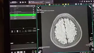 Performing Brain, Cspine, MRCP and shoulder MRIs Magnetom Vida 