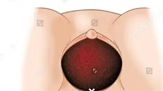 Episiotomy Procedure आसान भाषा में | Normal Delivery Care