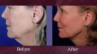 Augusta Facelift - Atlanta, Aiken, Columbia and Buckhead