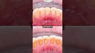 Myths and Facts about Dental Veneers at My Gentle Dentist 🦷✨  #dentalcare #dentalwellness