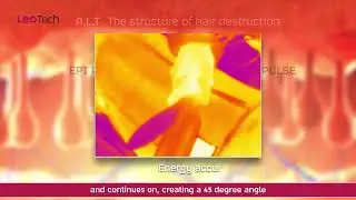Hyper Pulse Hair Removal Device for clinics