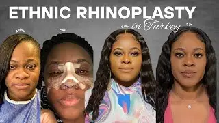 Rhinoplasty Q&A| I GOT A NOSE JOB IN TURKEY | Morning skincare routine | Dr Bora Ok