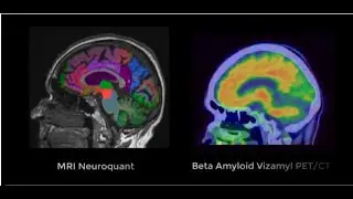 Beta Amyloid Vizamyl PET/CT Case 4