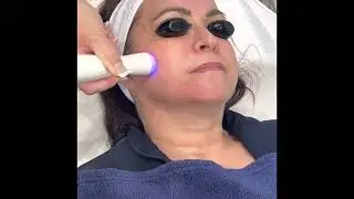 Radio Frequency, LED light and lymph drainage the Dermatherm RF Trio - Face & Body contouring