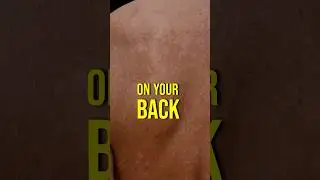 Noticing white patches on your back or chest? It might be more common than you think!🤔