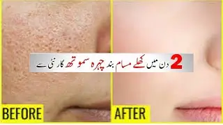 open Pores treatment | How To Naturally Treat Enlarged Pores (Skin Care)