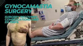 Gynocamastia Surgery: Recovery, Complications and ER visit