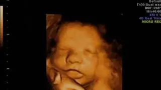 34 Week 3D ultrasound Snip6