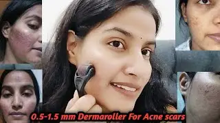 0.5 - 1.5 mm Dermaroller For Acne Scars || Replace,Uses, Benifits,Side effects All Details