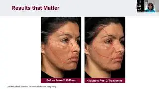 ThermaFrax with Dr Marina Buckley