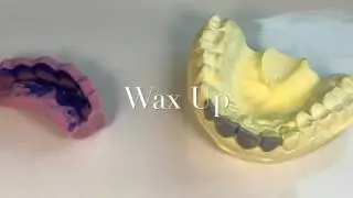 WaxUp & MockUp for Smile Design