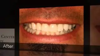 Dr. McElroy Uses CEREC&reg; For One-Visit Crowns