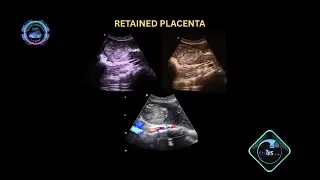 Retained Placenta | Ultrasound case