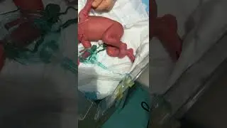 IV Cannula Insertion in Preterm Newborn | 28 Weeks | NICU Care تركيب الكانيولا