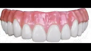No More Rocking Dentures &ndash; Secure, Comfortable Smiles Start Here!