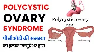 Reverse PCOD.. guaranteed benefit | पीसीओडी का इलाज एक्यूप्रेशर से | Dr S Ranjan