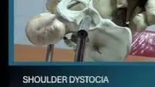 Shoulder Dystocia Management_Obstetrics_delivery@Love_Obs_Gynae