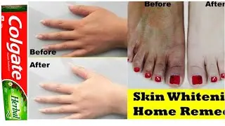 Toothpaste Colgate skin whiting home remedies