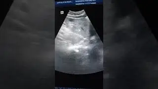 Usg video's, multiple hepatic cysts.