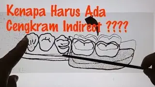 indirect Retainer pada Gigi Tiruan Sebagian Lepasan#prosthodontics