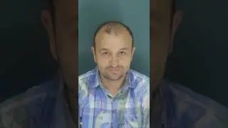 🌟 After the hair transplant, all eyes are on our patient! #hwtclinic #hairtransplantturkey #hair