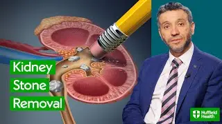 Варианты удаления камней из почек | Литотрипсия, уретероскопия и чрескожная нефролитотрипсия (ЧНЛТ)