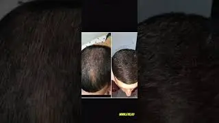Cresterea parului cu minoxidil🧔🏽&zwj;♂️🤯🔥 #beard #foryou #hairgrowth #beardgrowth #minoxidilresult