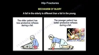 Hip Fractures Mechanism Of Injury - Everything You Need To Know - Dr. Nabil Ebraheim