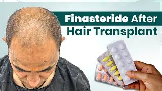 Hair Transplant नंतर FINASTERIDE किती गरजेचे ? Hair Transplant in Pune | New Roots