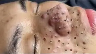Extreme Blackhead Removal on Nose &ndash; Satisfying Deep Cleansing