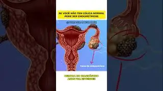 A&iacute; eu te pergunto... essa dor &eacute; s&oacute; c&oacute;lica ou pode ser endometriose? 😰 #curiosidades