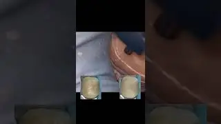 The precise, effective, cleaning of a CrystalMark Air Abrasion unit!