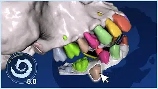 BSP5.0: Delete Teeth from a Model INSTANTLY!