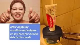 After  applying  Vaseline and Colgate Toothpaste for 3weeks on my face.  this is the result.