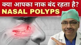 Nasal Polyps surgery | Should I get the operation done or not??