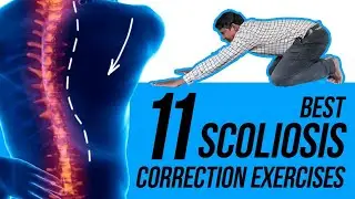11 Easy Scoliosis Posture Correction Exercises