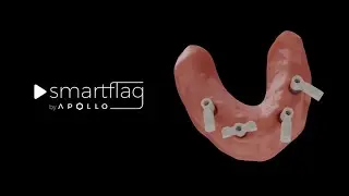 SmartFlag Explained | Digital Quality Control for Dental Restorations