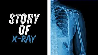 The X-Ray: From Lab Curiosity to Life-Saving Medical Technology